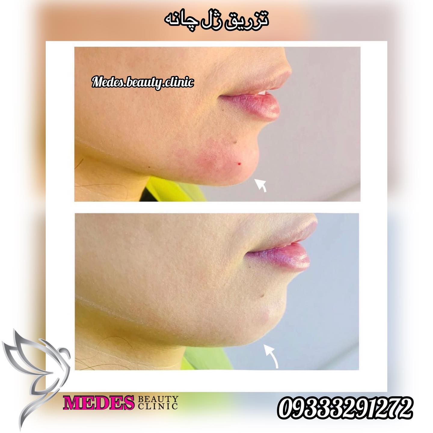 گالری زاویه سازی صورت